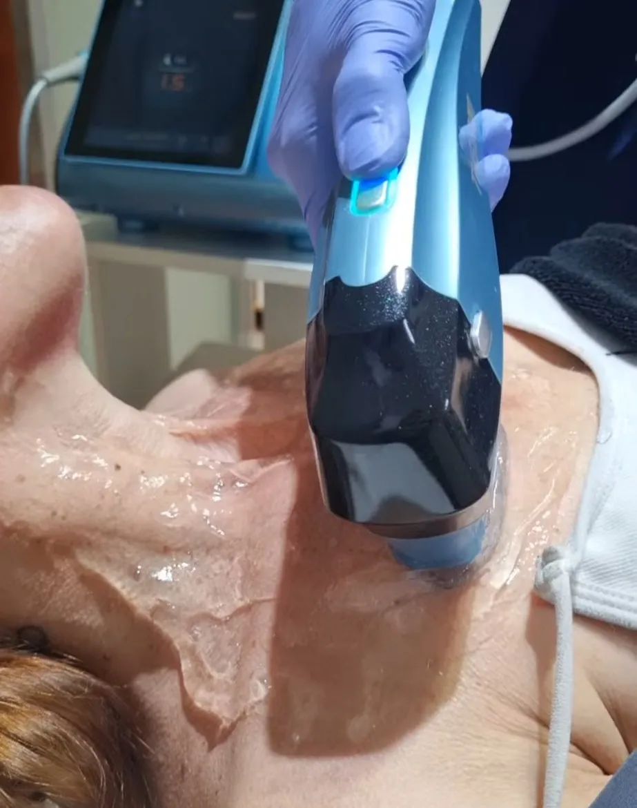 HIFU en el cuello en Vitafy