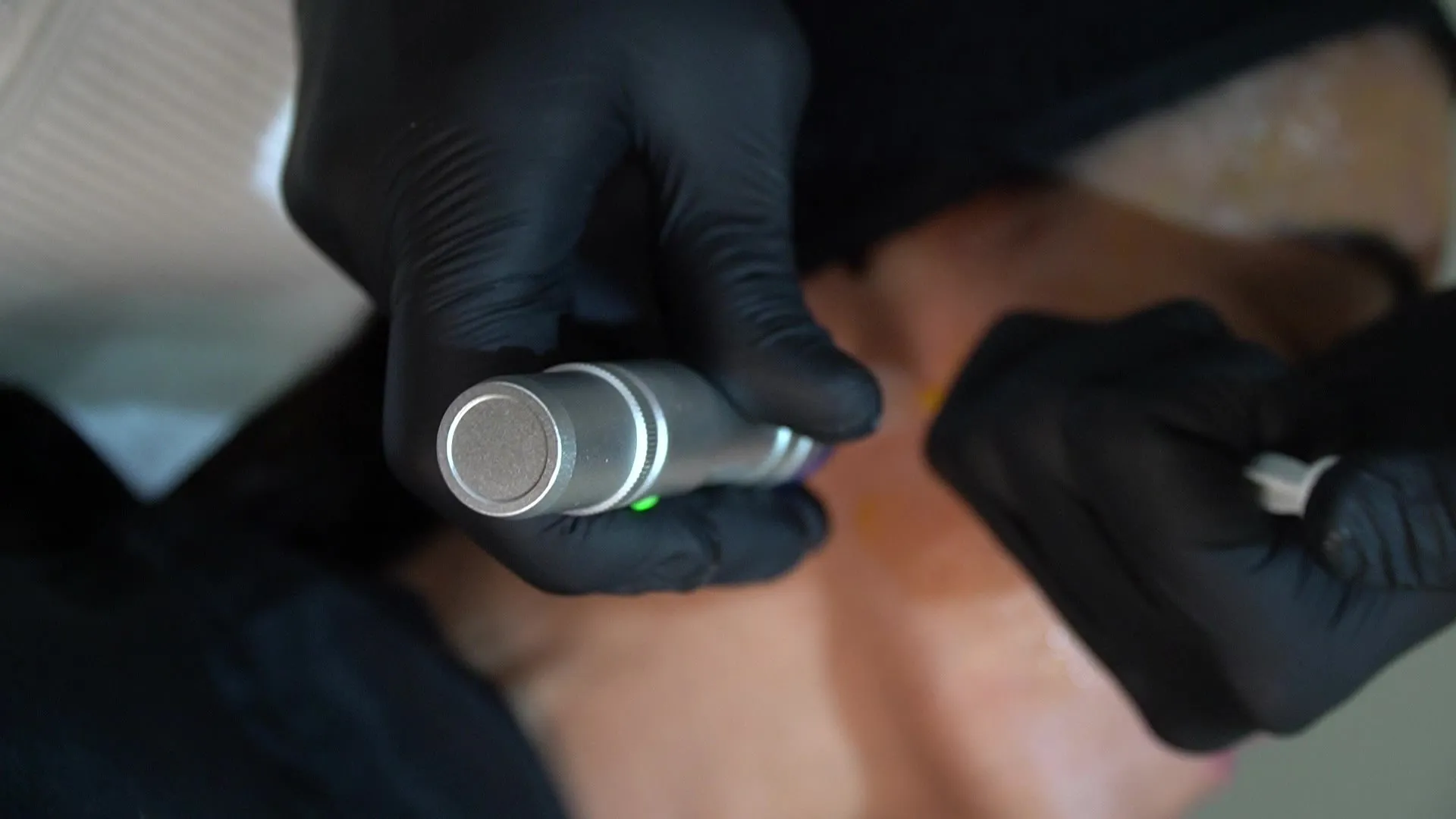 Dermapen durante un tratamiento facial